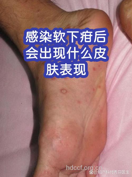 软下疳早期症状有哪些？