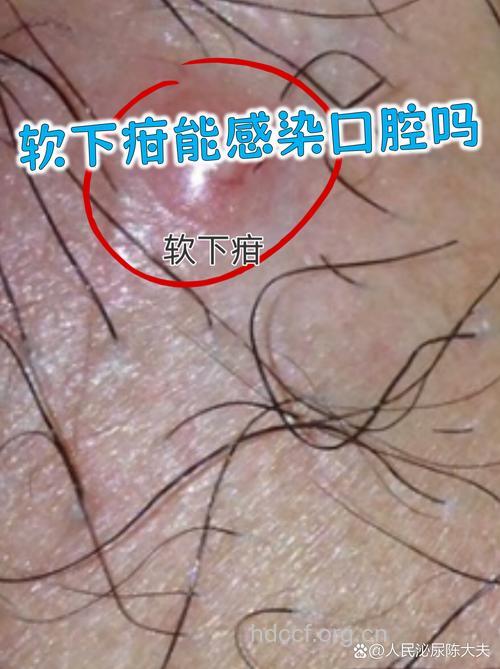 男性患软下疳几率远远高于女性