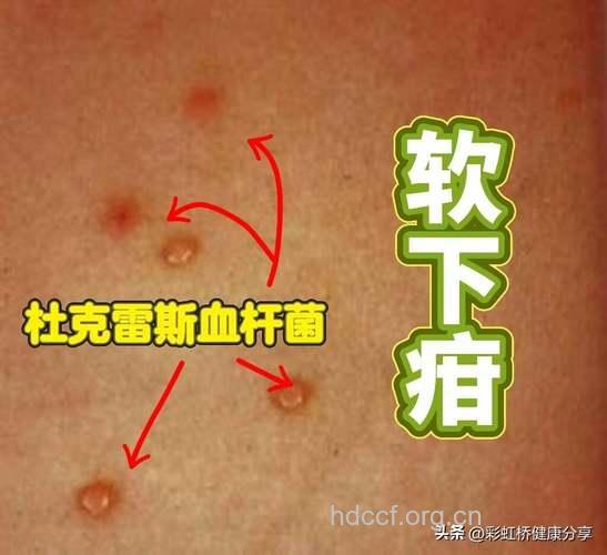 揭密软下疳的6大种类