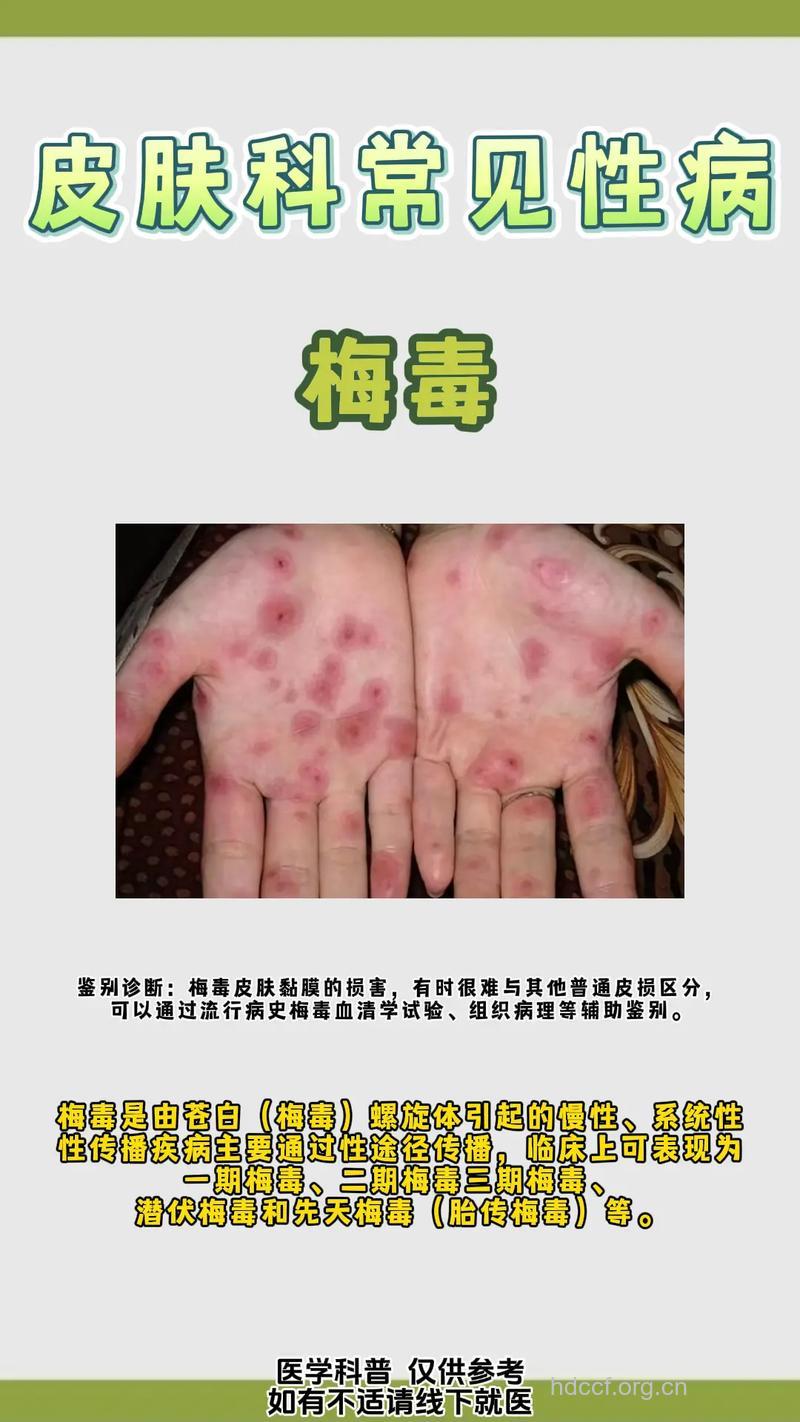 性病主要有哪些分类