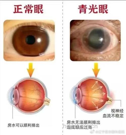 闭角型青光眼会引起头痛吗