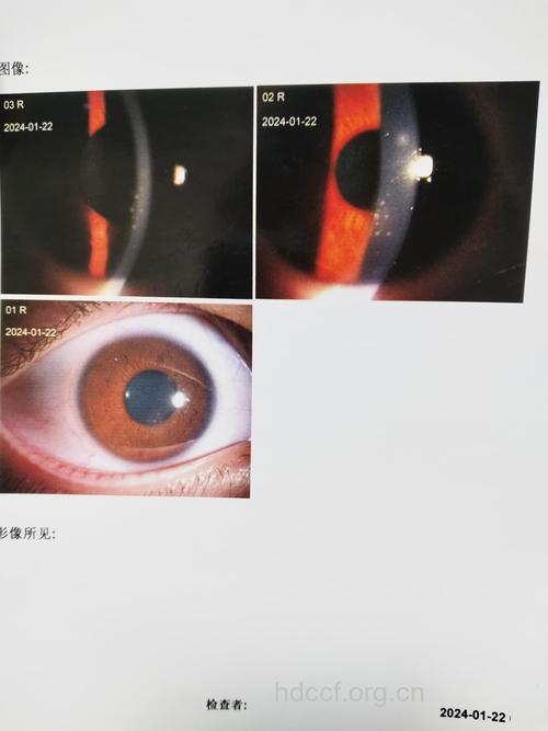 青光眼睫状体炎综合征的症状