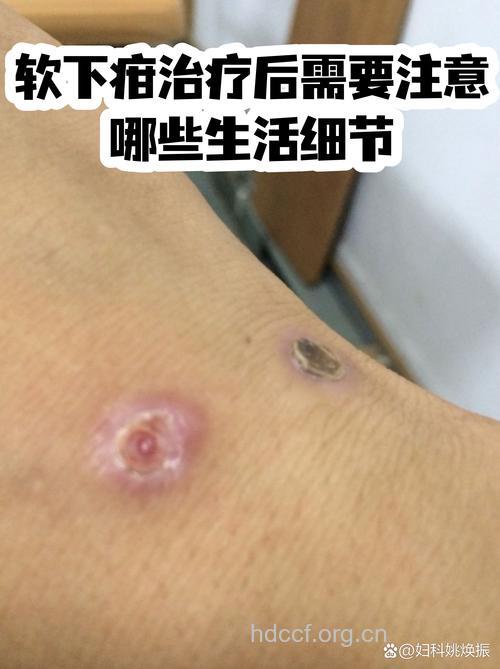 教你用外用药治软下疳