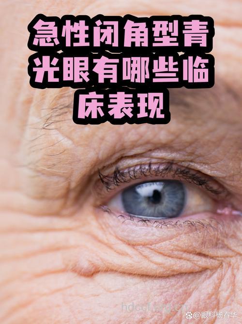 眼胀是闭角型青光眼症状吗
