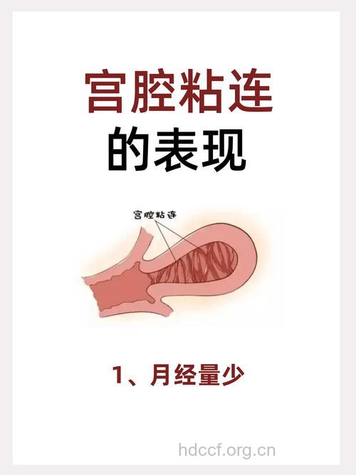 宫颈粘连有哪些发病征兆