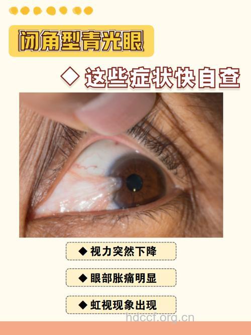 闭角青光眼的临床有什么症状