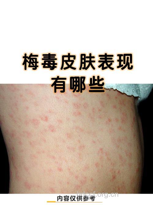 梅毒疾病的症状表现都有哪些