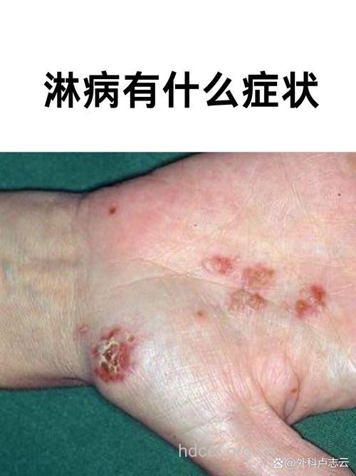 淋病的早期表现有哪些