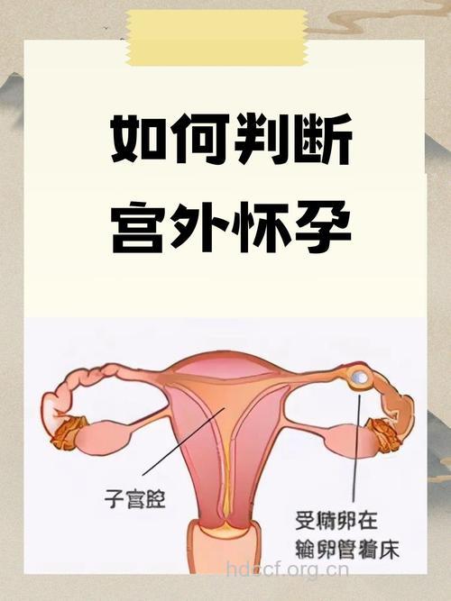 怎么判断是否是宫外孕