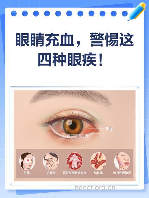 哪些原因导致白领红眼病
