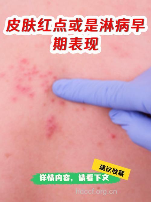 淋病患者的早期的几种症状