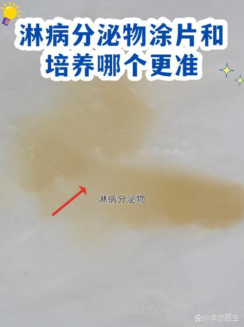 淋病的五种实验室检查方法