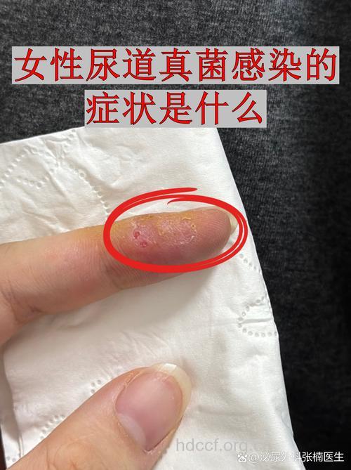 尿急尿痛 女性淋病常见的早期症状