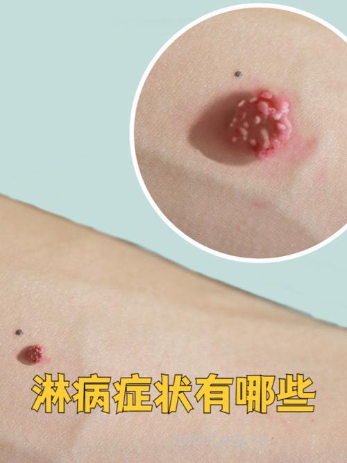 淋病患者的初期症状与诊断