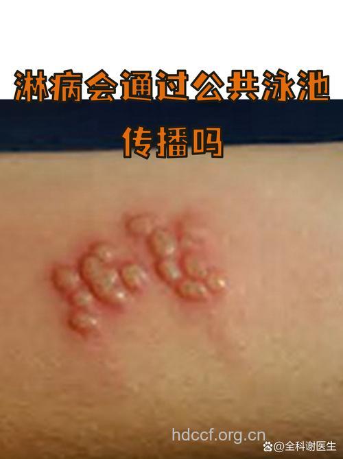 游泳会被传染淋病吗