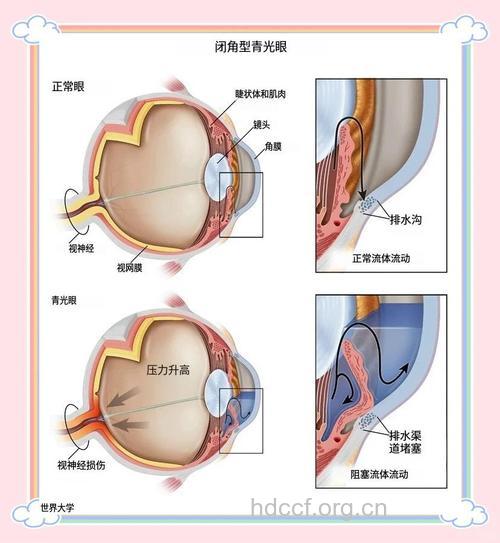 怎么正确应对闭角型青光眼