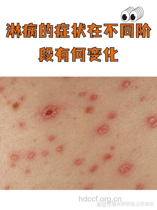 淋病的5个常见早期症状