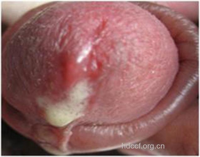 患上淋病有哪些明显的症状