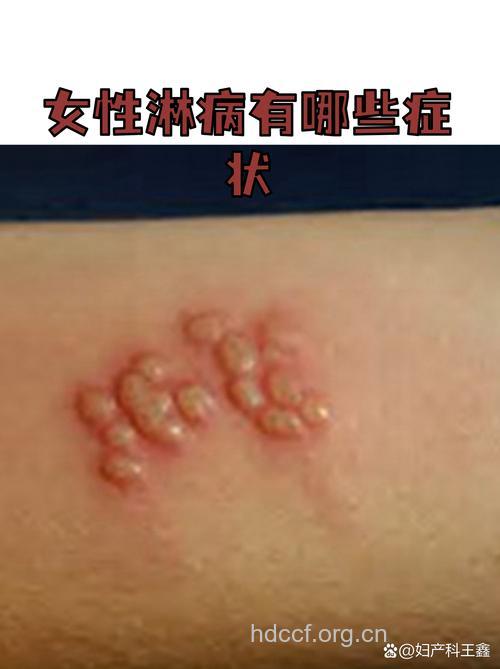女性淋病患者的早期症状