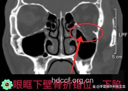 怎么确诊眼眶骨折方法