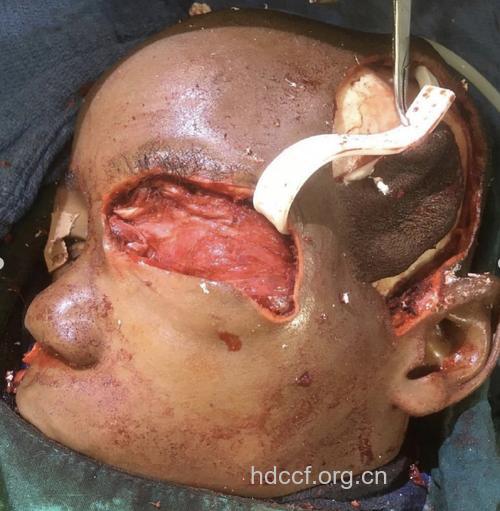 眼眶横纹肌肉瘤有哪些诊治方法