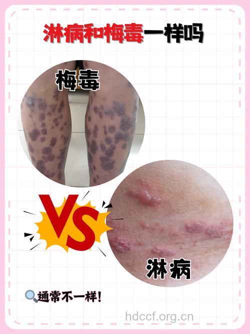 性病恐怖症有哪些危害