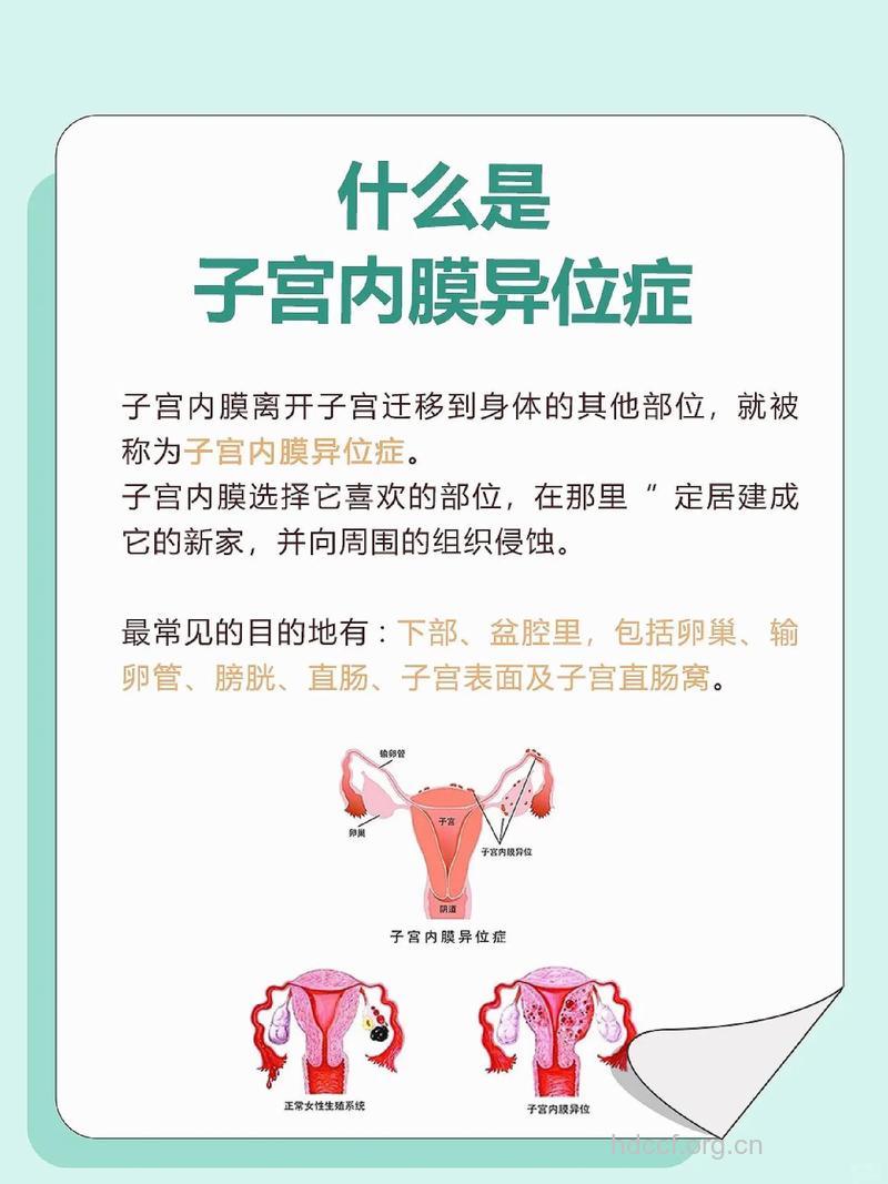 子宫内膜异位也会带走你的“孕”气