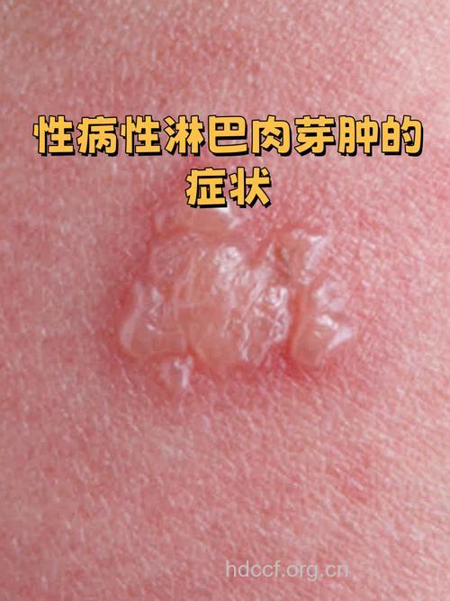 患上性病性淋巴肉芽肿的症状