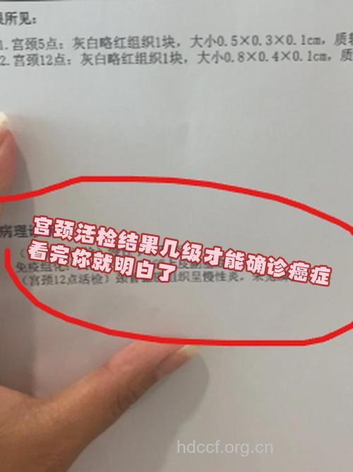 宫颈癌检查太频繁会导致不孕