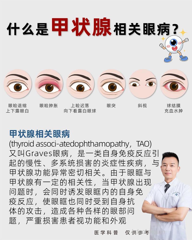 甲状腺疾病会引发哪些眼科疾病