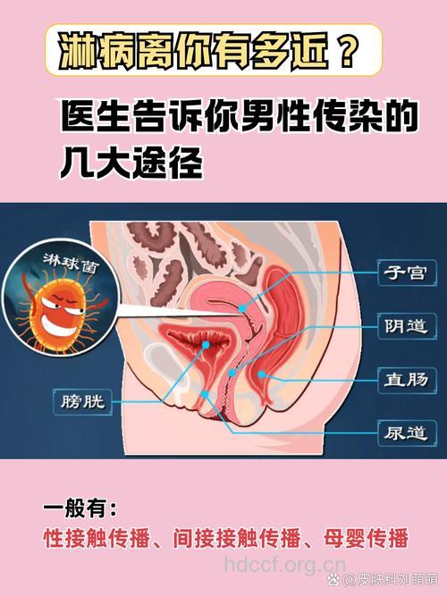 男性感染淋病的三大途径