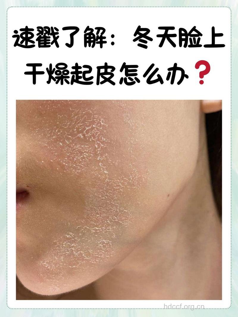 最容易引起冬季皮肤干燥的6大恶习