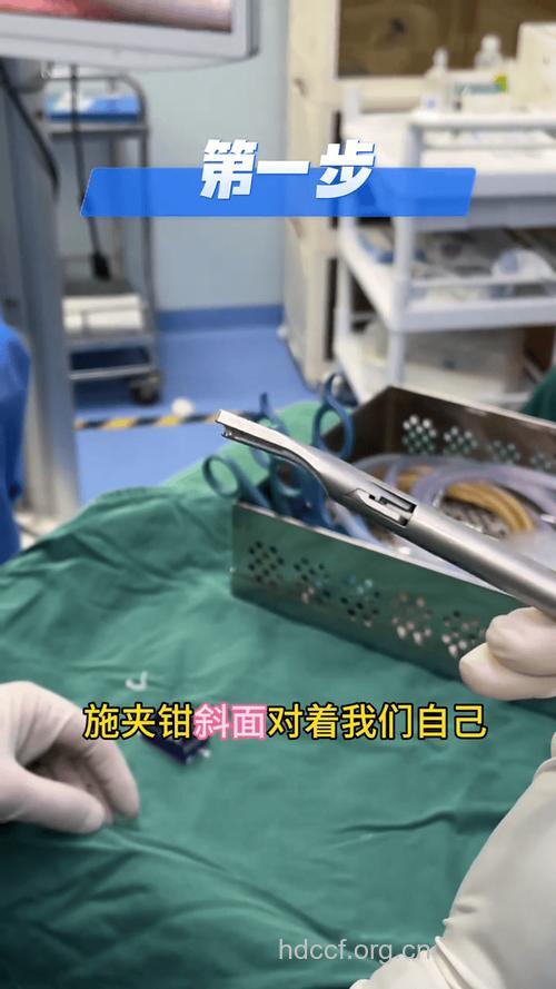 钳夹术手术步骤