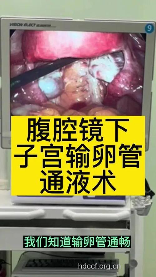 宫腔镜行输卵管通液术效果更好