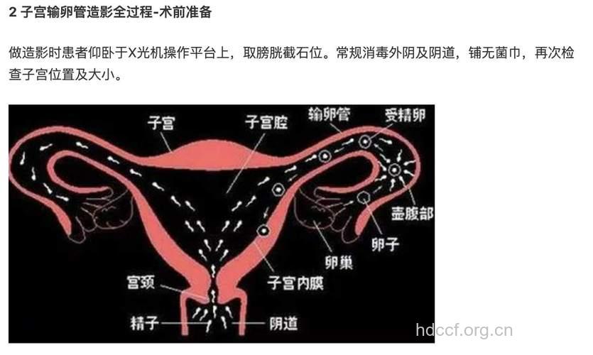 子宫输卵管造影的适应症