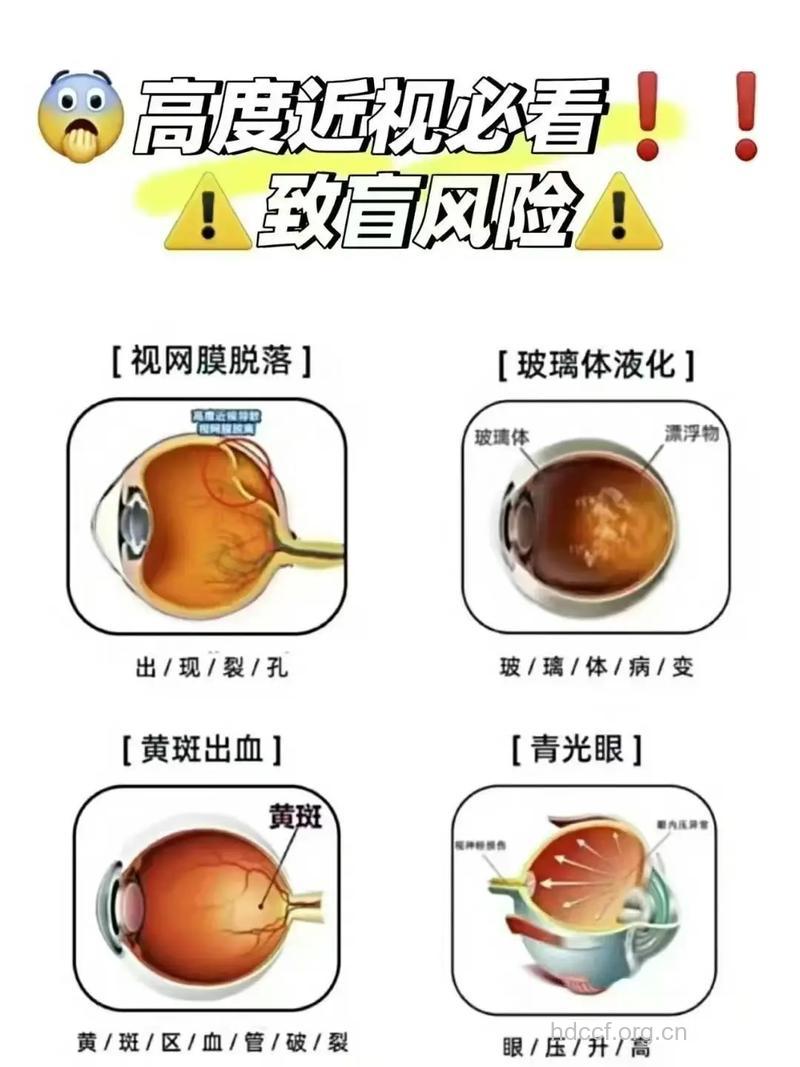 高度近视会引发哪些疾病