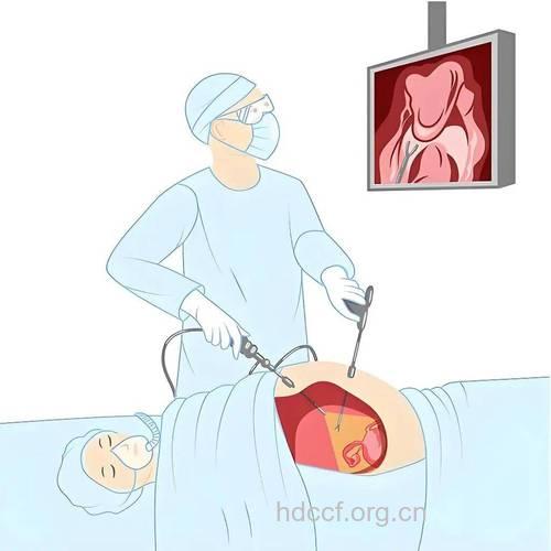 腹腔镜解决盆腔问题