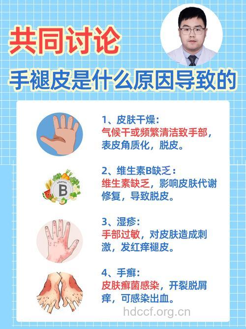 冬季脱皮原因大不同 手汗多也易脱皮