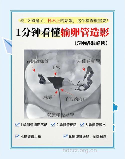 输卵管造影检查的意义