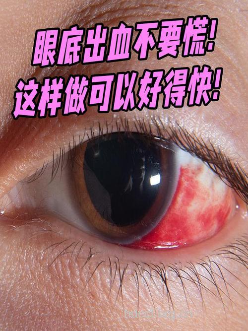 哪些眼病引起眼底出血