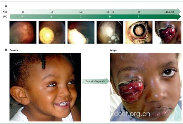 婴儿时期小心视网膜母细胞瘤