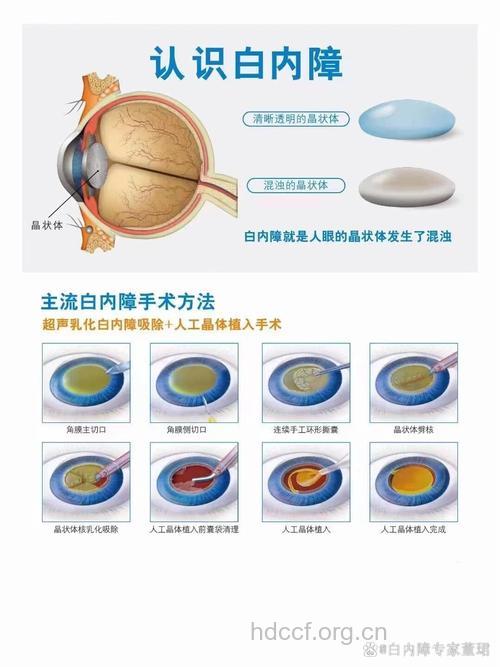 治疗白内障手术是唯一途径