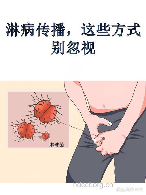 性不是淋病的唯一的传播方式