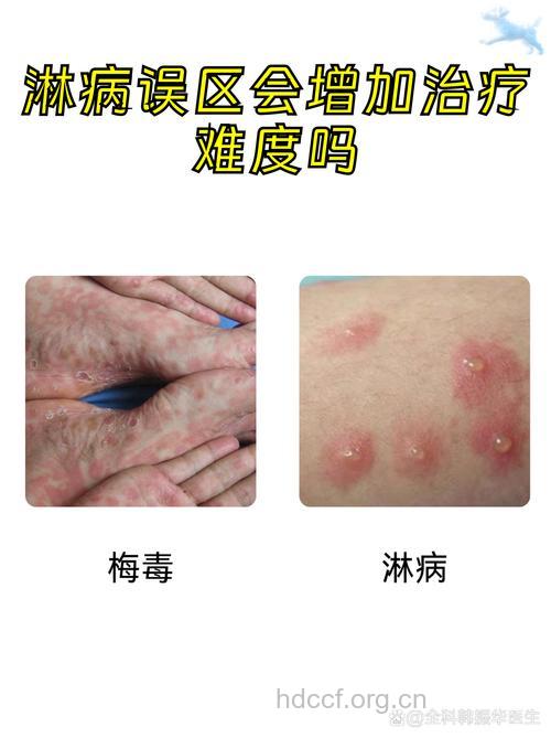 淋病的治疗误区有哪些