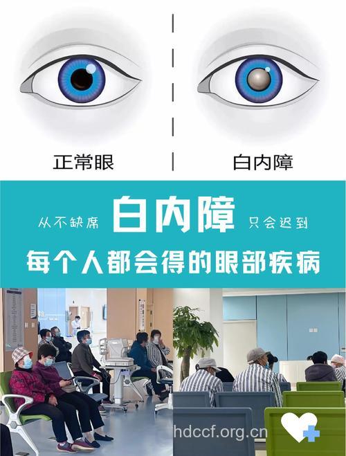 白内障要及早治疗