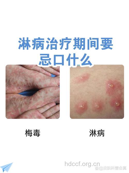 淋病的治疗食谱