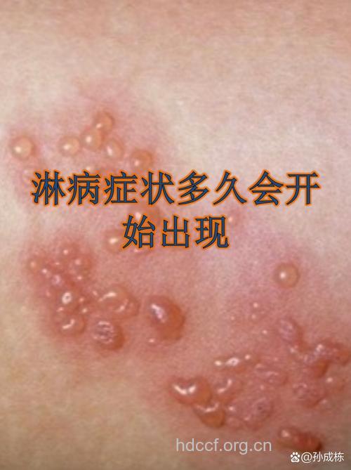 女性慢性淋病的症状有哪些