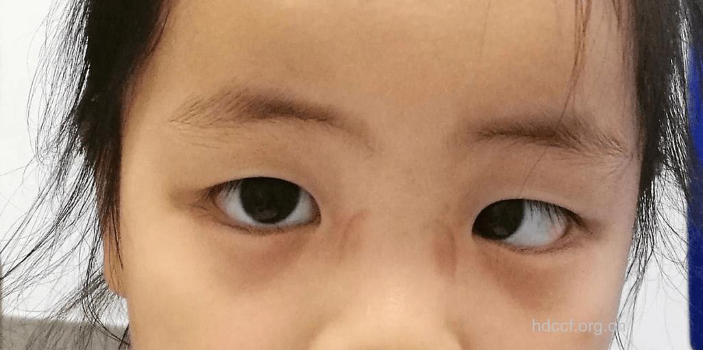 儿童斜视的症状