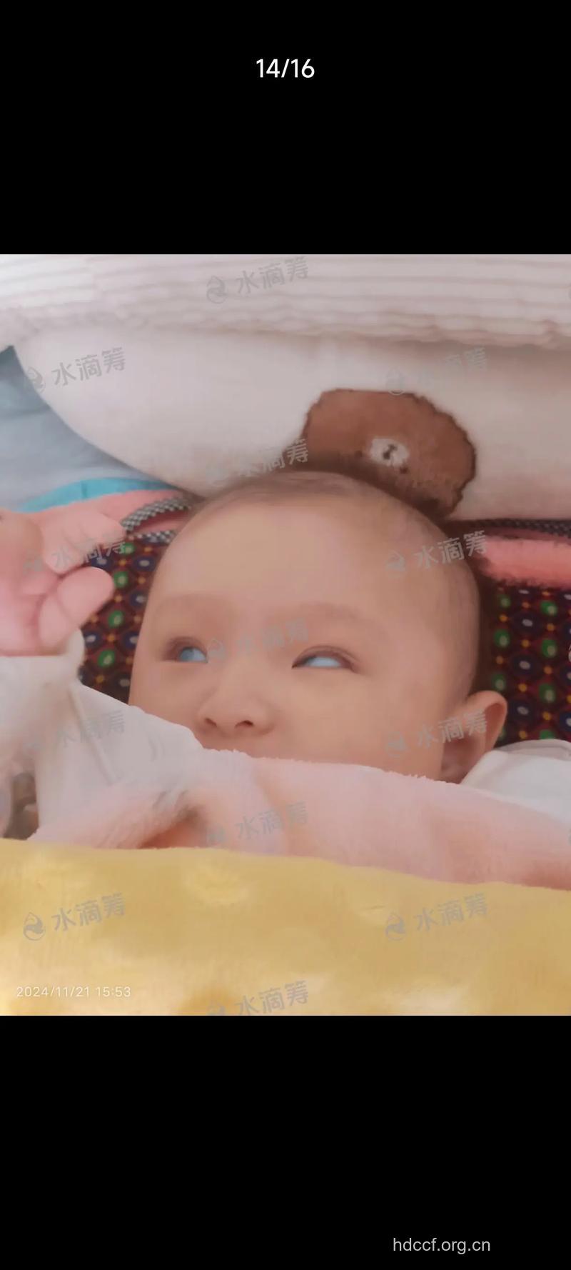 关注新生儿先天性白内障