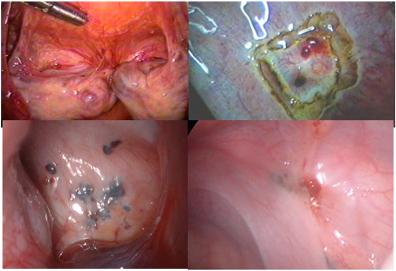 子宫内膜异位治疗——药疗+手术